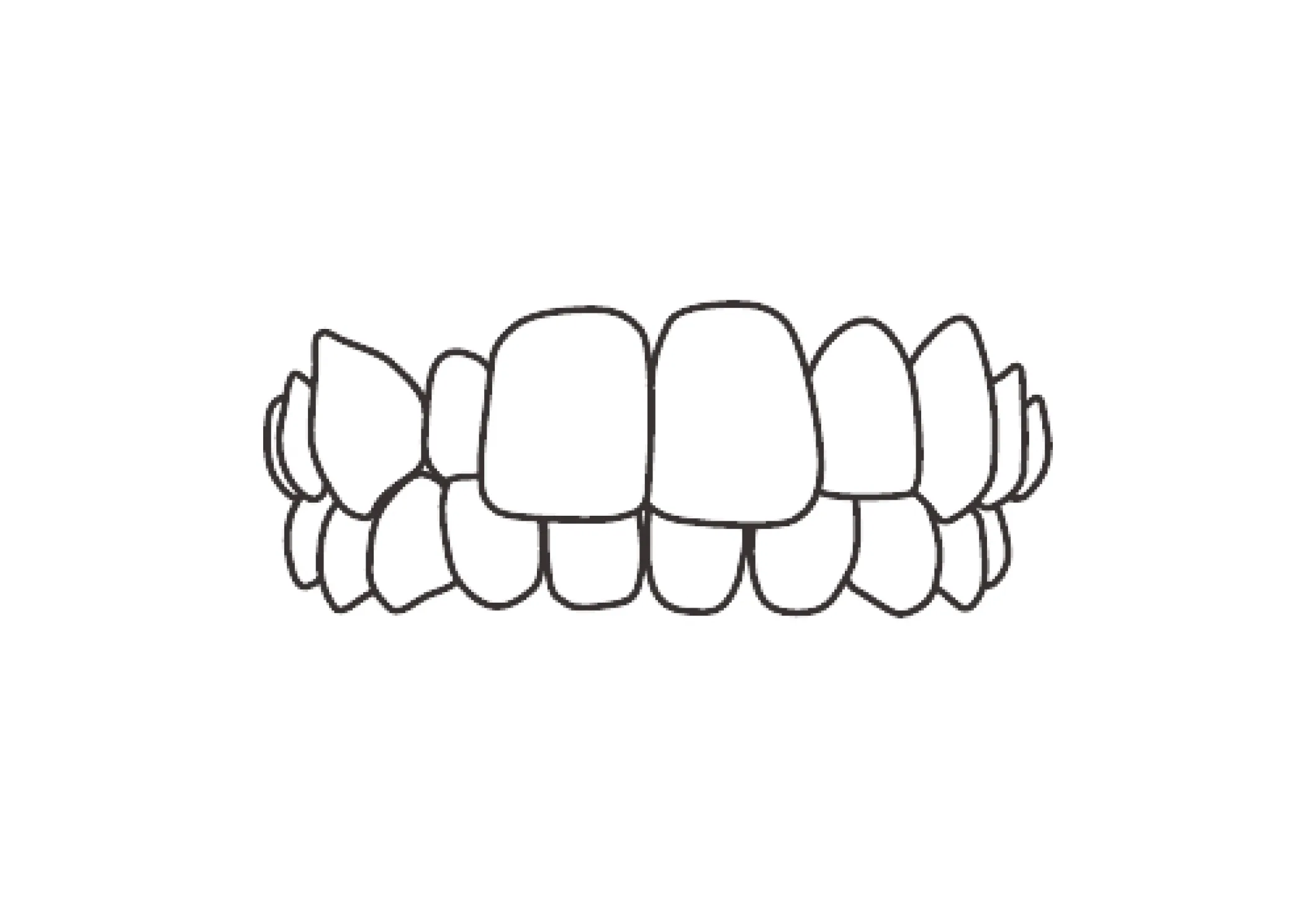 上顎前突（じょうがくぜんとつ）