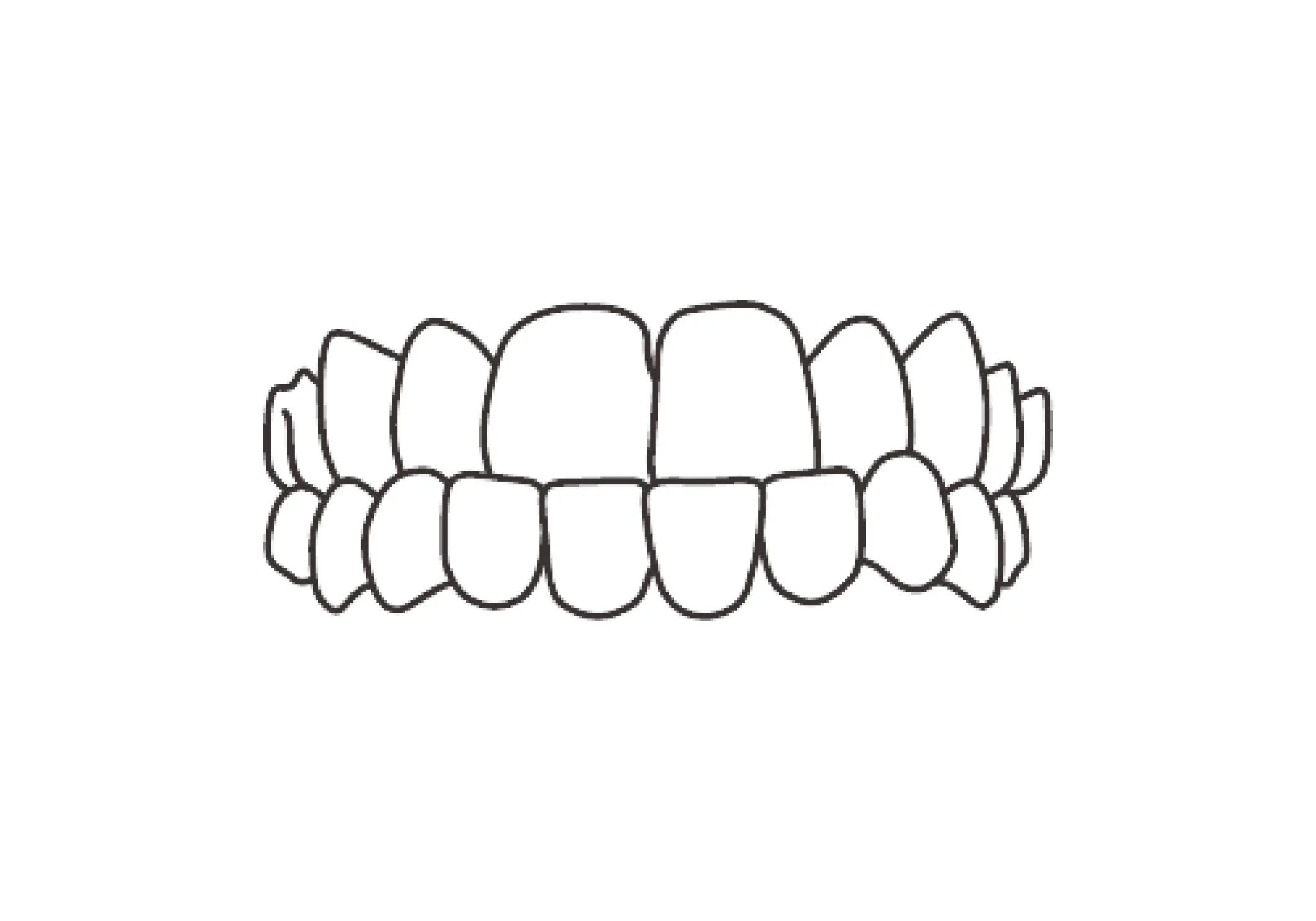 下顎前突（かがくぜんとつ）