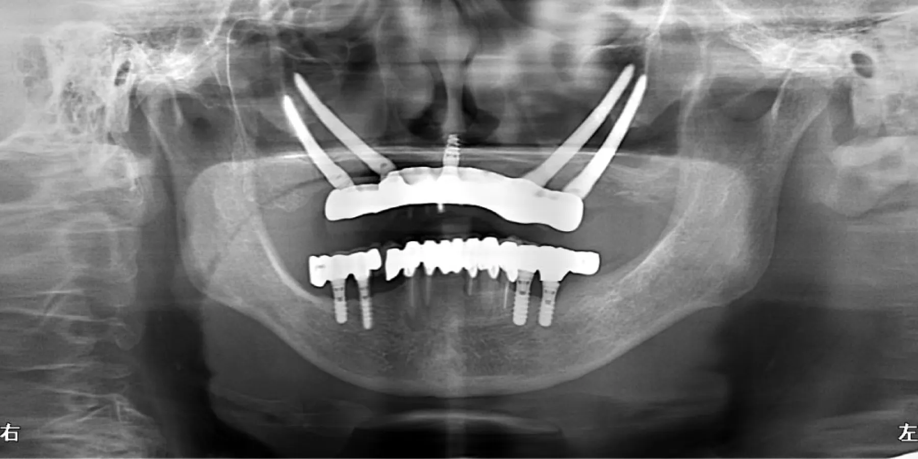 インプラント症例