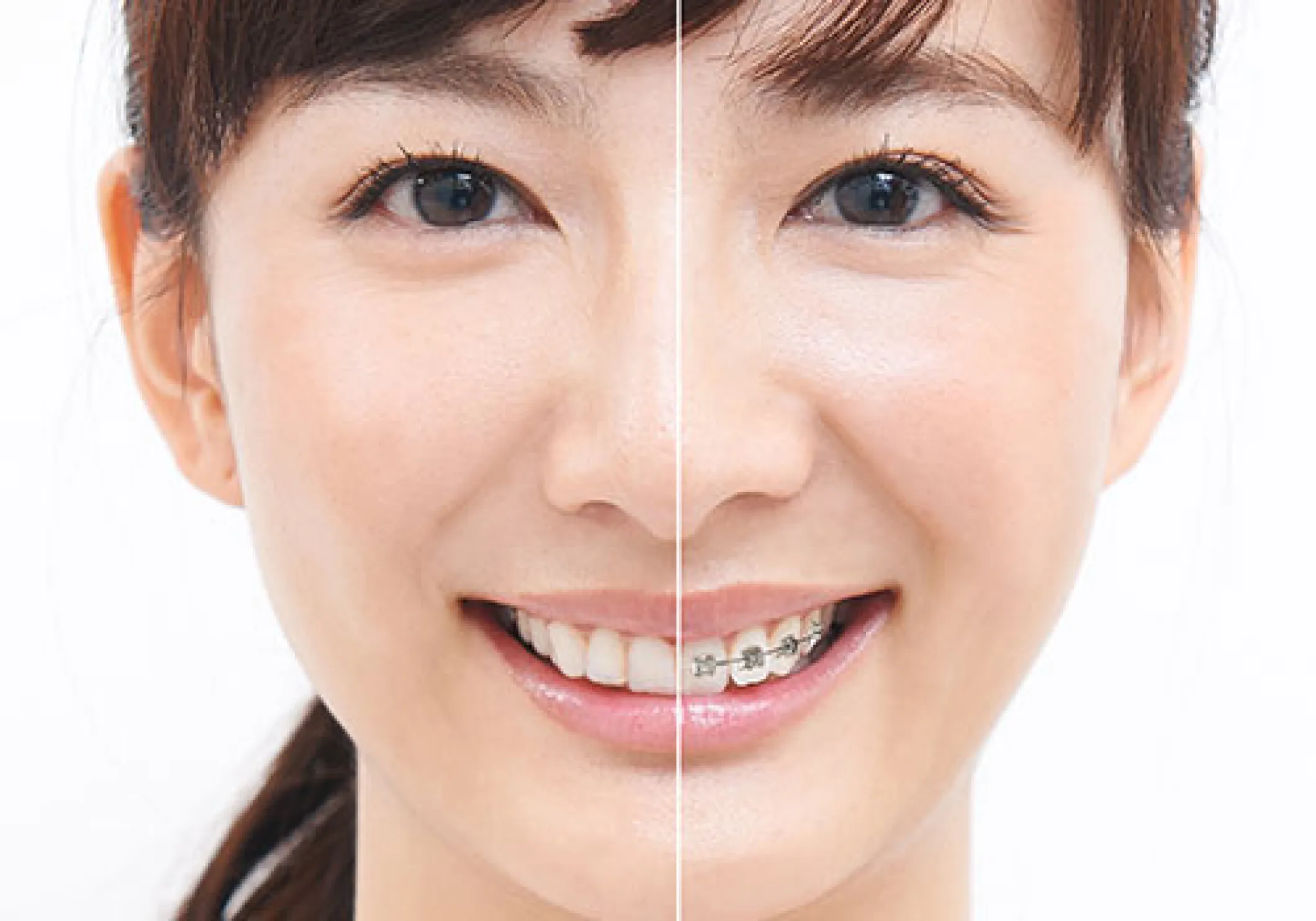 目立たない矯正装置