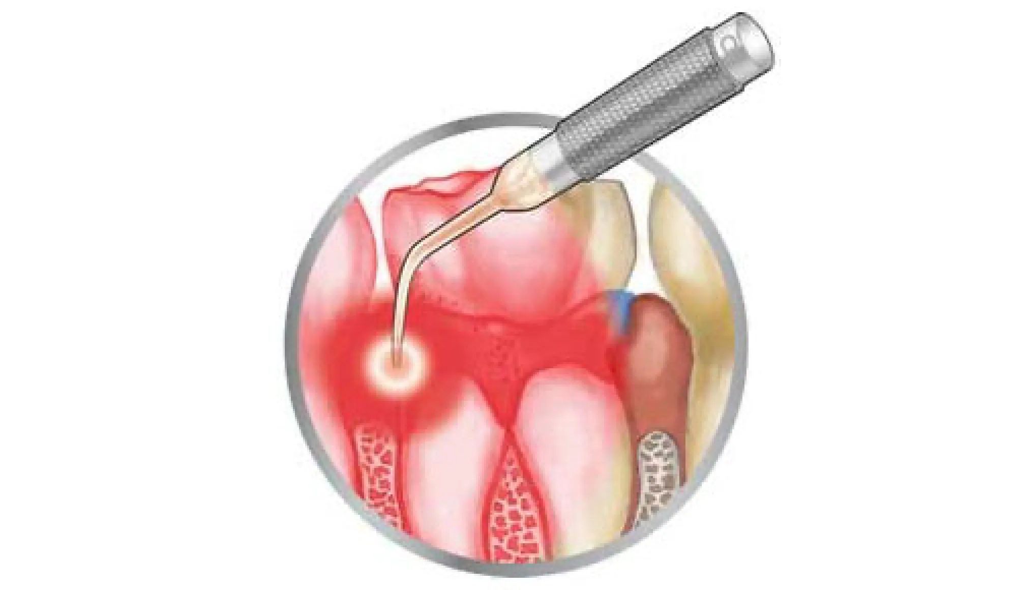 新しい歯周病治療ペリオウェイブ