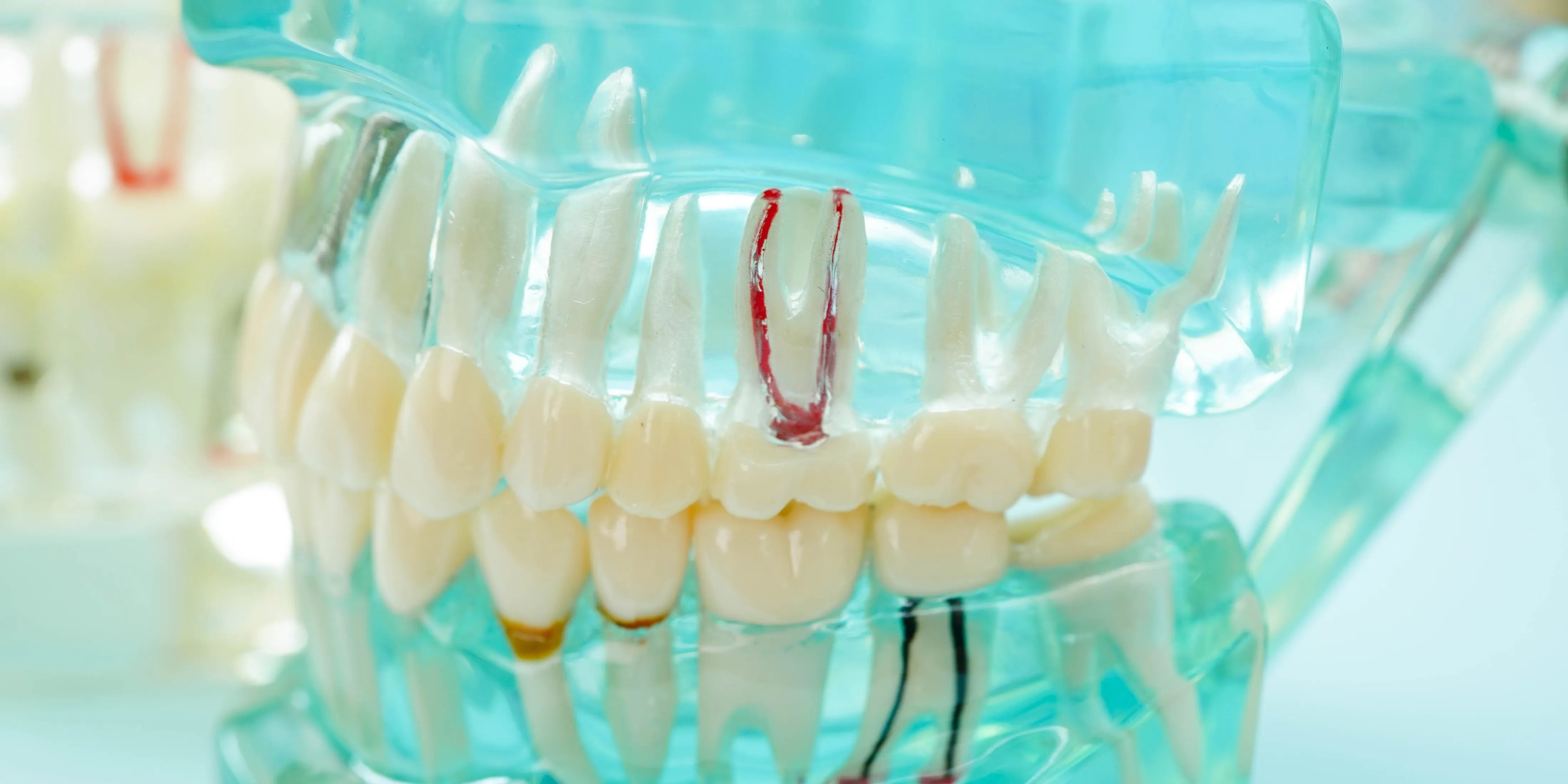 根管治療が必要な症状