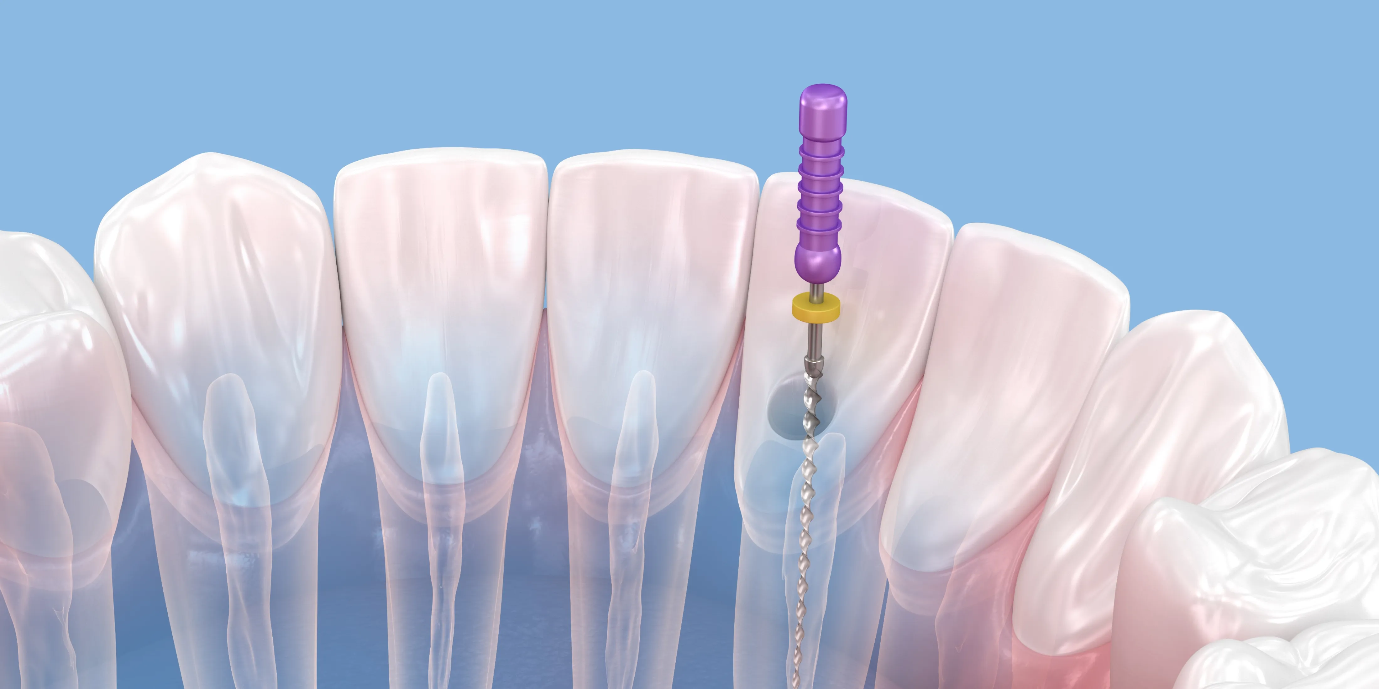 再発させないための徹底した洗浄と封鎖