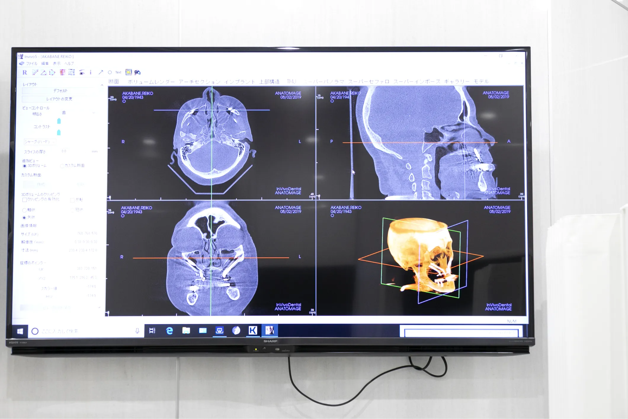 CTガイドによる安全な手術計画