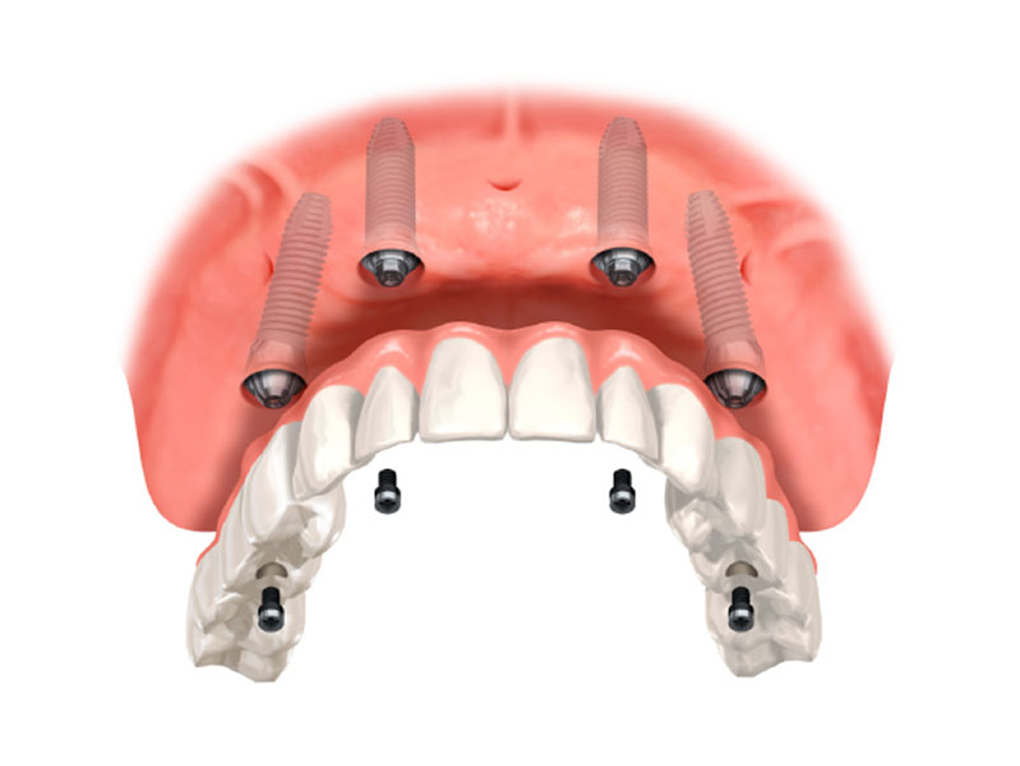 欠損した歯の代わりに埋入された歯科用インプラント体のイメージ図