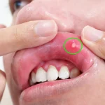 【埼玉】口内炎治療の費用は？保険適用で安心の歯医者