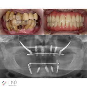 インプラント症例1（ザイゴマ）