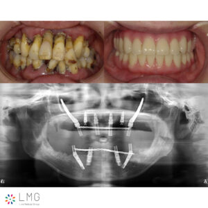 インプラント症例2（ザイゴマ）