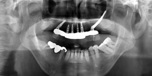 インプラント症例3（ザイゴマ）