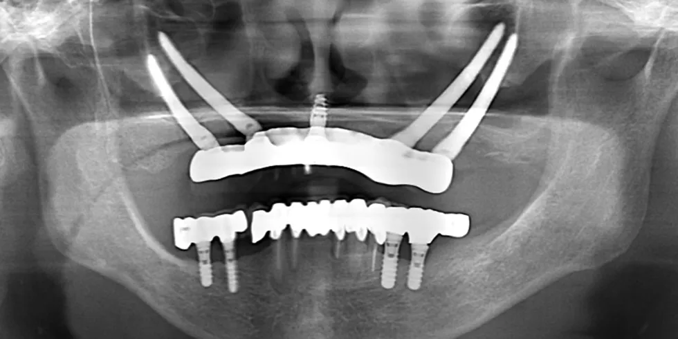 手術前パノラマX線写真