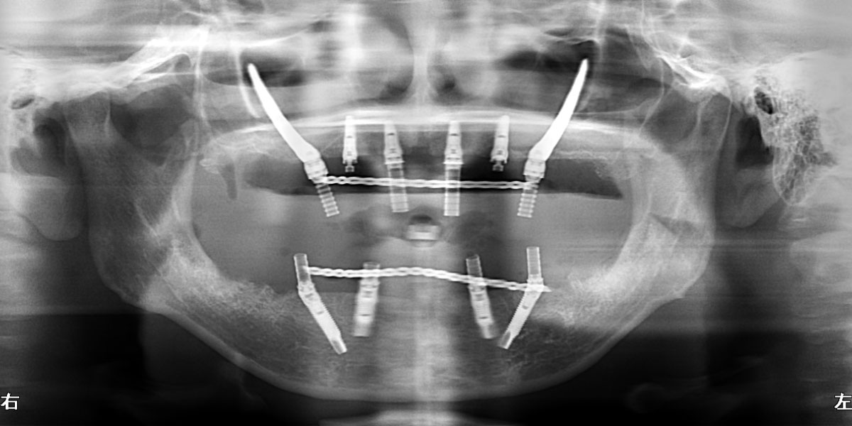 手術後パノラマX線写真