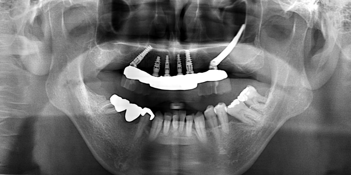 手術後パノラマX線写真