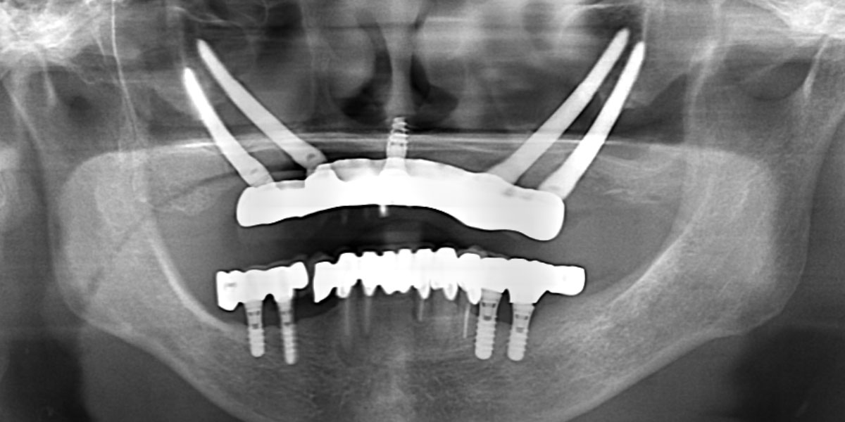 手術後パノラマX線写真