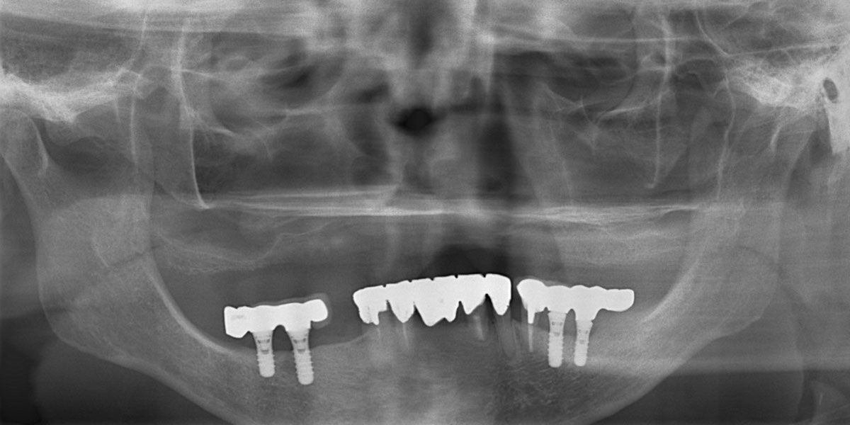 手術前パノラマX線写真