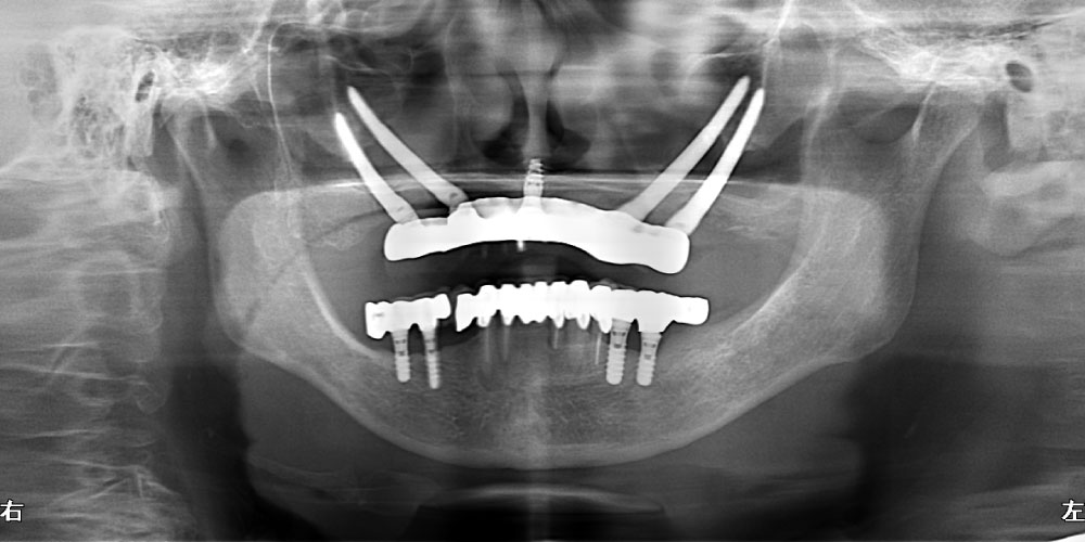>インプラント症例